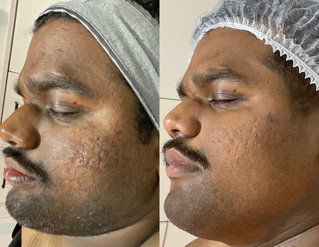 What Aesthetic Treatments Work Best on Dark Skin?