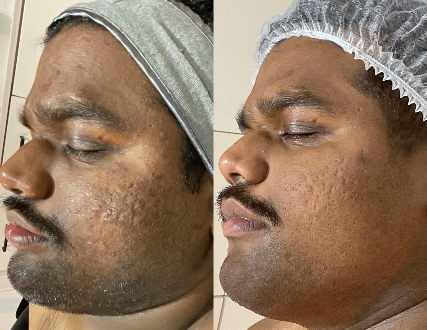 What Aesthetic Treatments Work Best on Dark Skin?