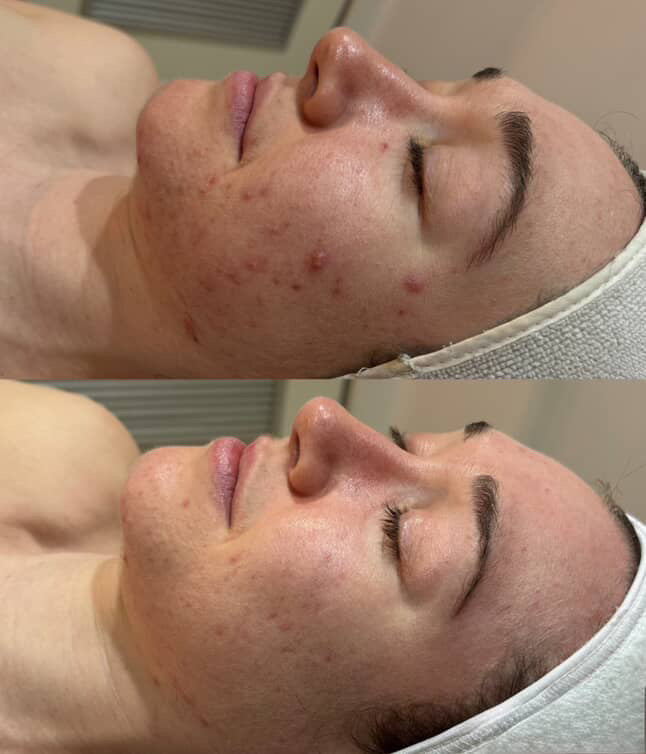 Before and after comparison of a person's face with acne on the top and clear skin on the bottom.