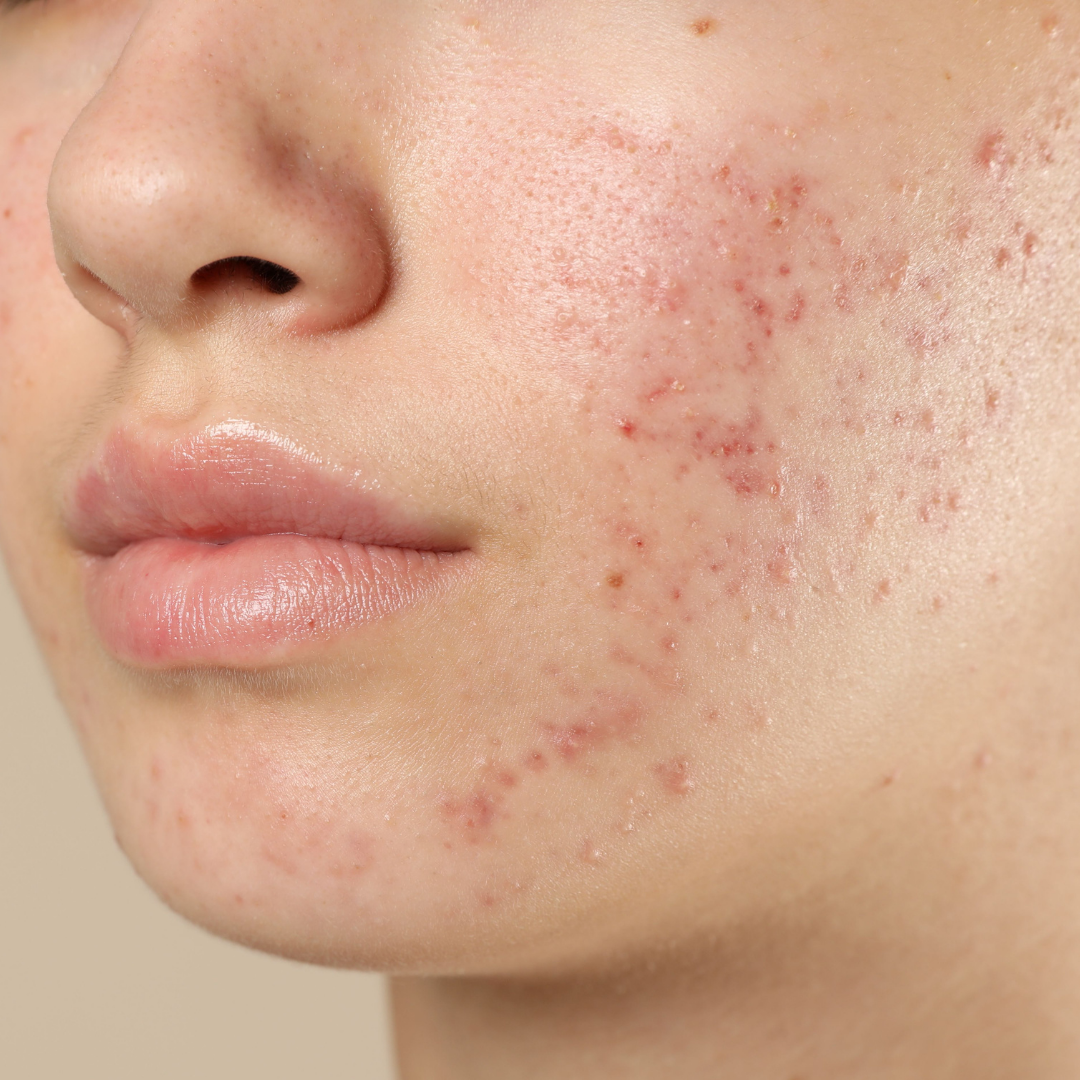 Close-up of a person's face with acne on a beige background