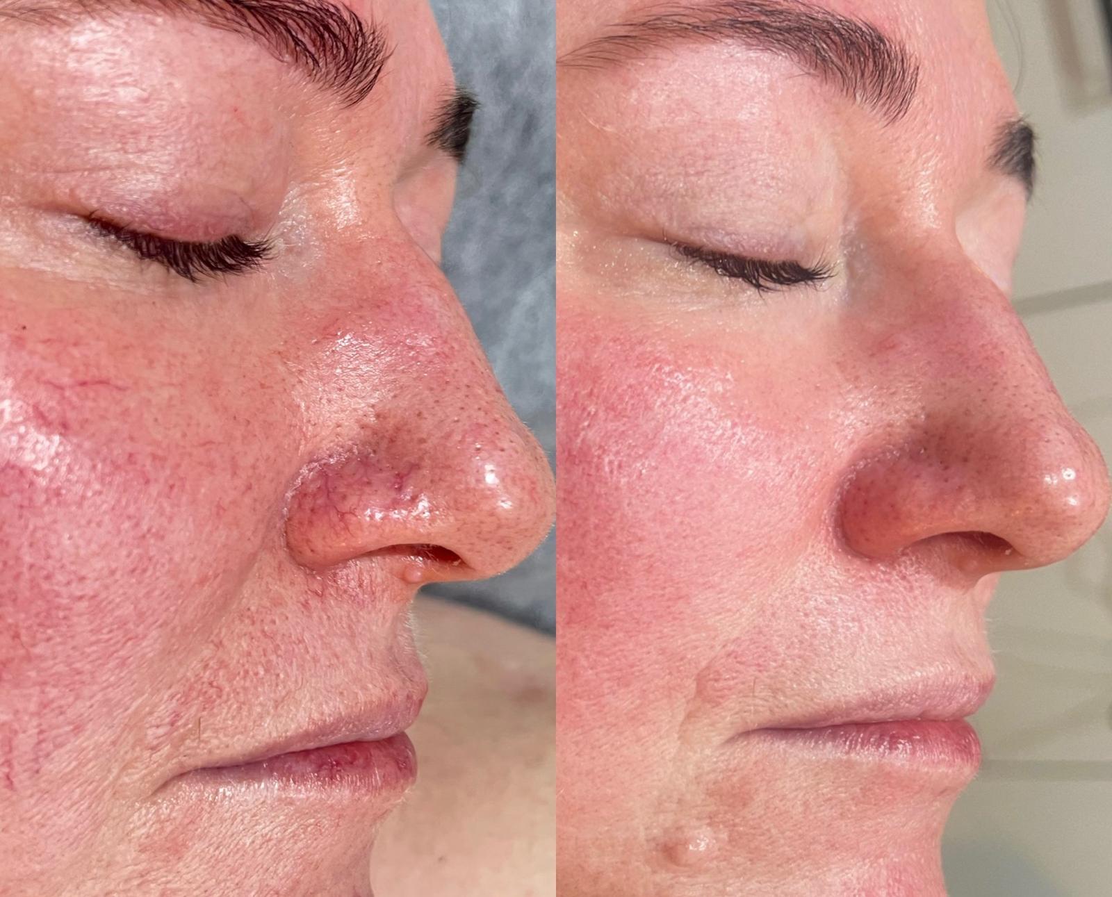 A side-by-side close-up facial comparison of a person's nose and cheek area, showing before-and-after skin texture and appearance.