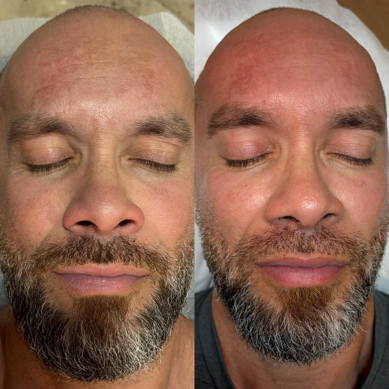 Before and after treatment result