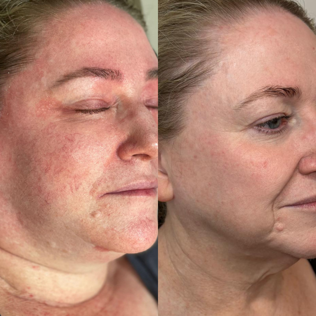 Before and after comparison of a woman's face after barrier repair treatment